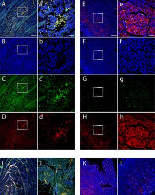 Bv8 mediates myeloid cell migration and enhances malignancy of colorectal cancer